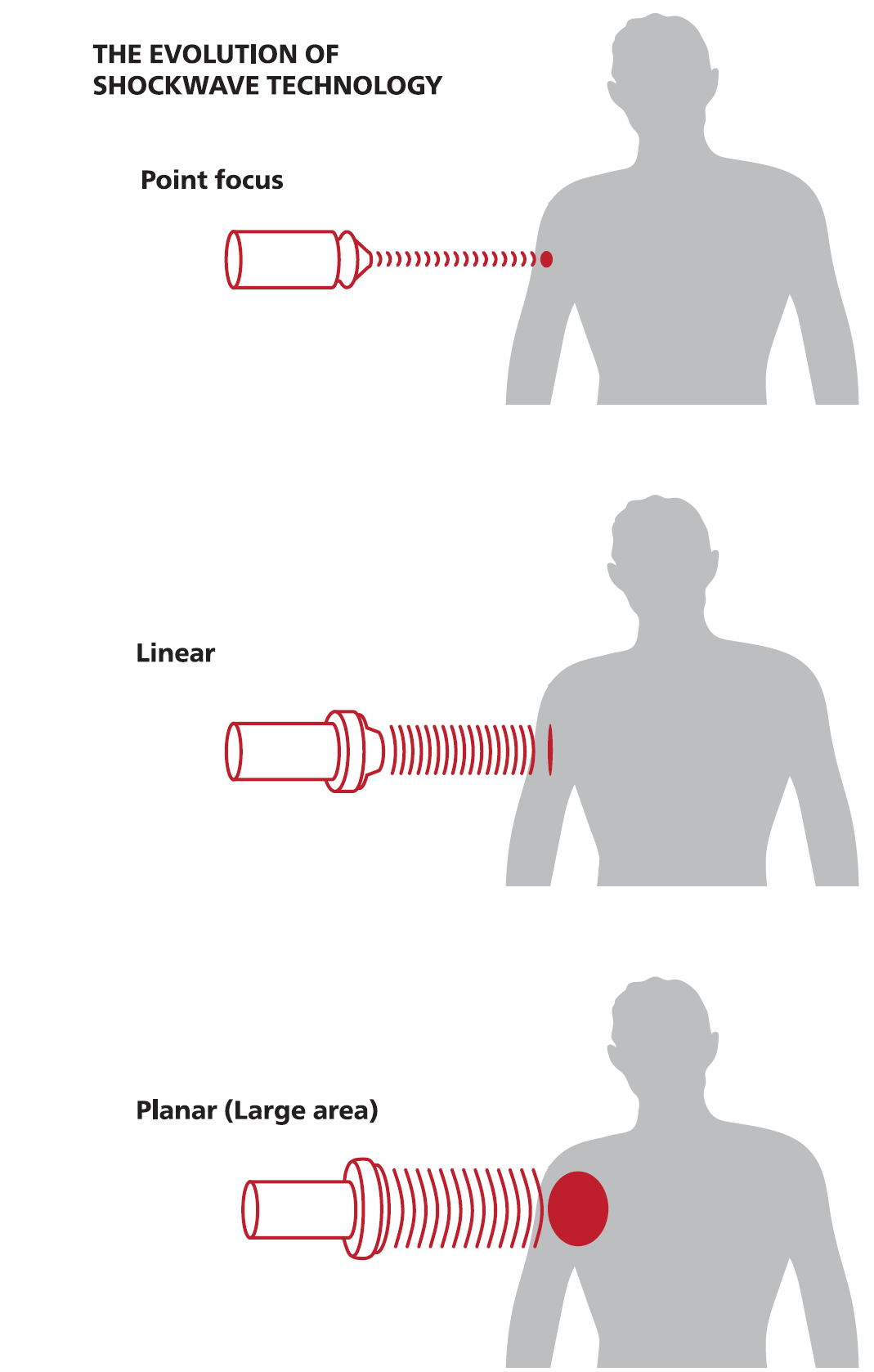 shockwave treatment morenova